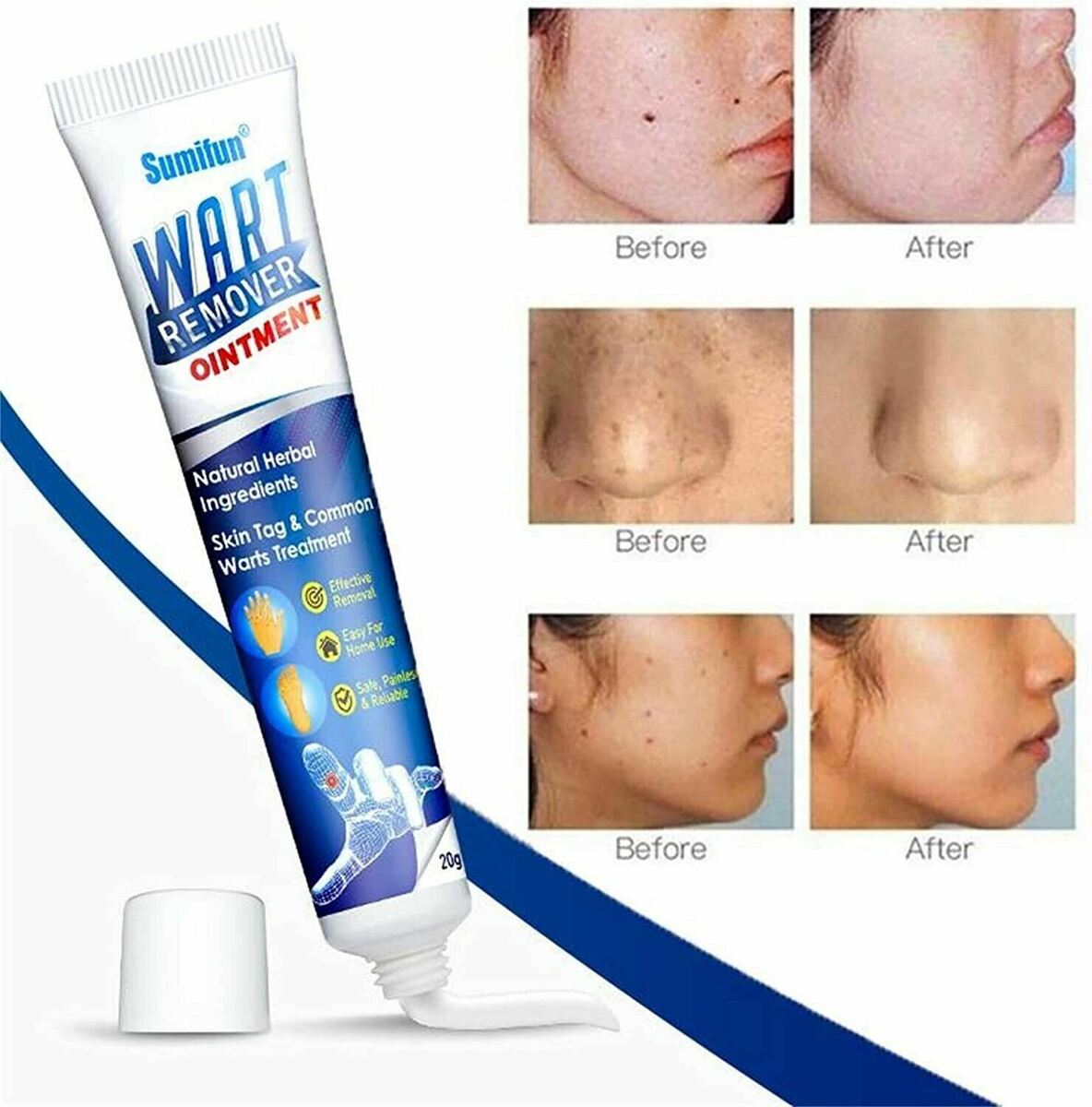 Crème médicale naturelle pour les verrues cutanées