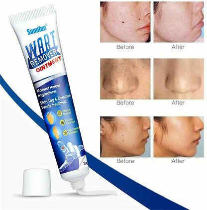 Crème médicale naturelle pour les verrues cutanées